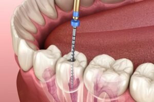  Root Canal Treatment in CTM