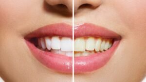 Clear-Aligners-in-Ahmedaba