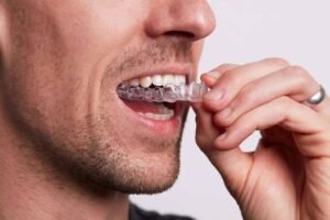 Clear Aligners in Ahmedabad