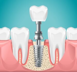  Dental Implant Cost in India