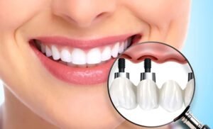 dental implant cost in ahmedabad