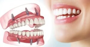 best dental implants in ahmedabad