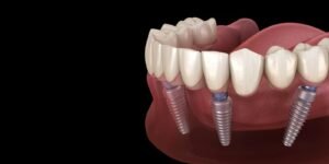 best dental implants in ahmedabad